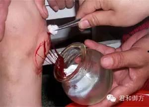 刺血拔罐法教学视频,传统中医养生技巧全解析