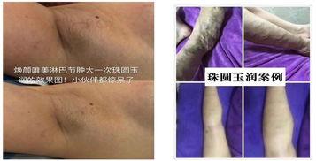 腋下和脖子黑吃二甲双瓜,告别腋下与脖颈黑斑困扰