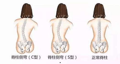脊柱侧弯视频,成因、症状及矫正方法一览