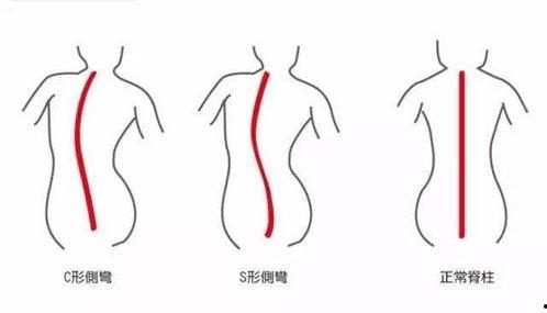 脊柱侧弯视频,成因、症状及矫正方法一览